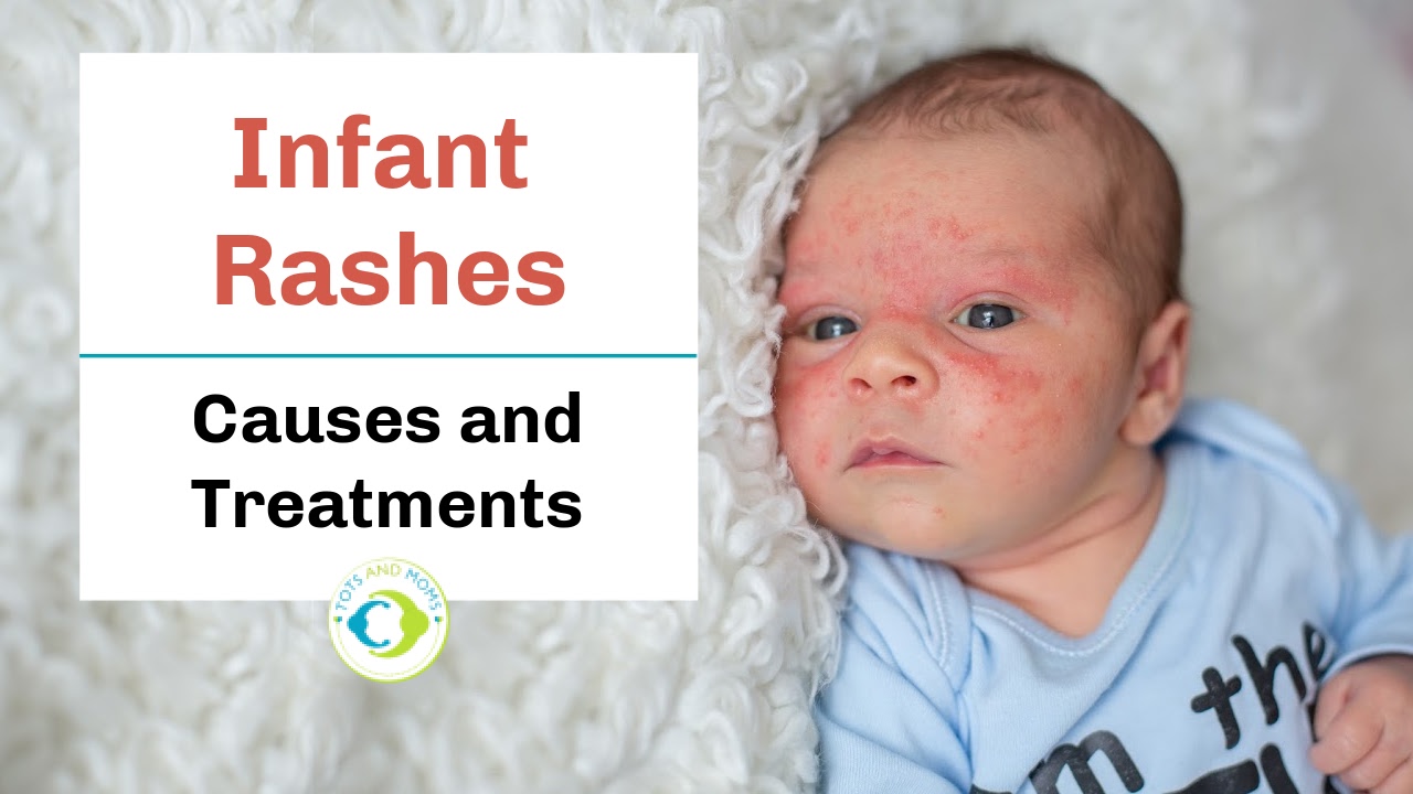Infant Rash Directory Infant Rashes Archives - TOTS and MOMS